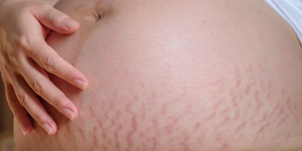 Stretch marks before using StretchAway Body Lotion