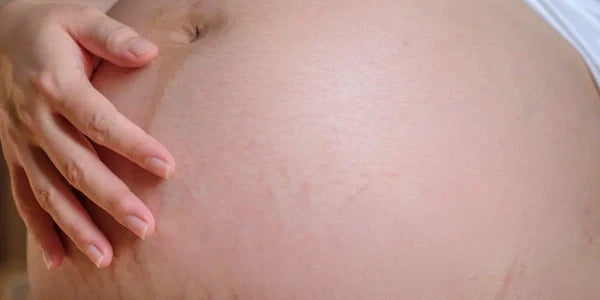 Stretch marks after using StretchAway Body Lotion