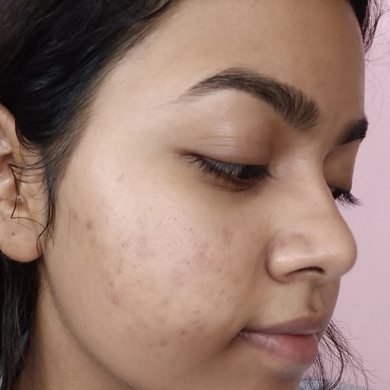 Dark spots and hyperpigmentation before using DarkSpot RX Serum