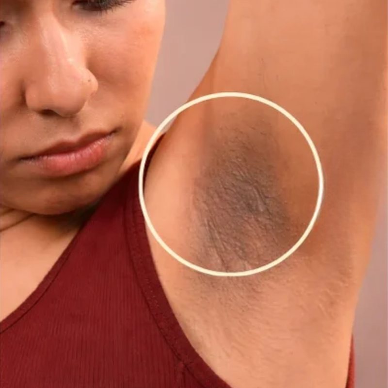 Dark underarms before using Pretty Pits
