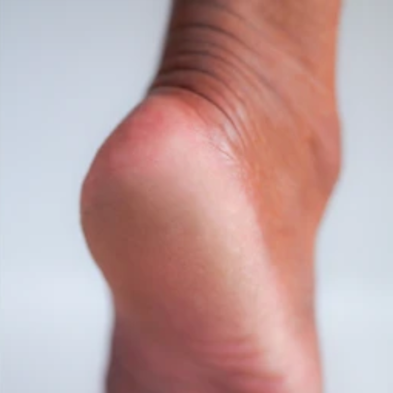 Healed soft heels after using Heelora