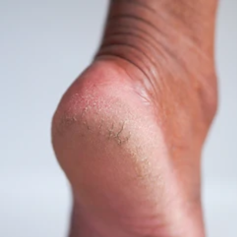 Cracked heels before using Heelora