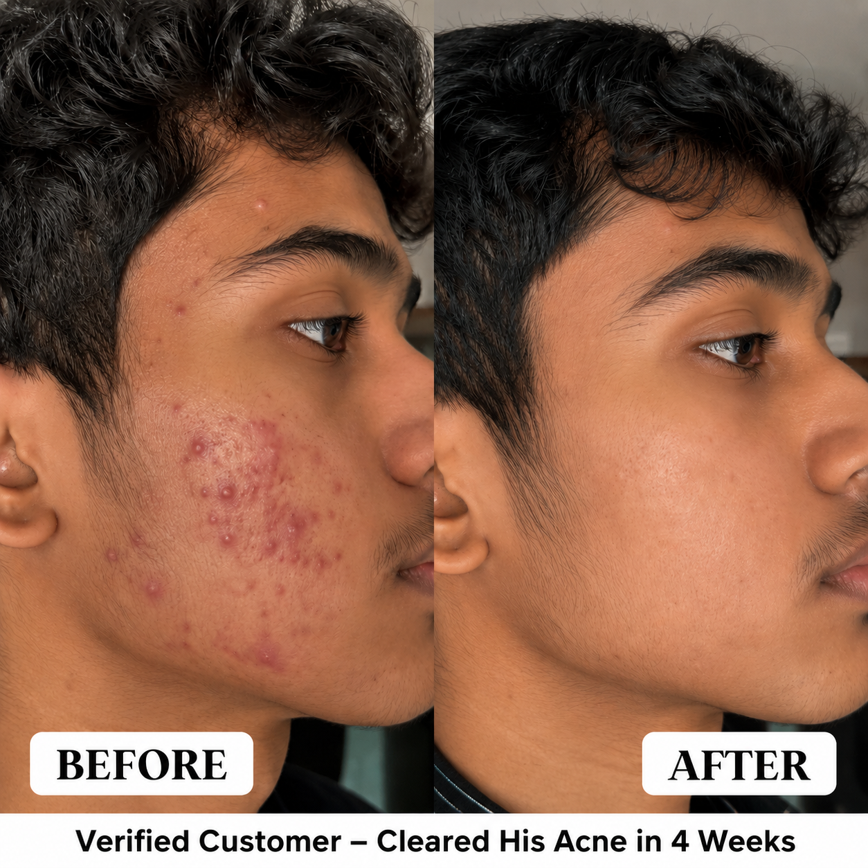 Before and after acne treatment results — clear skin in 4 weeks, verified customer